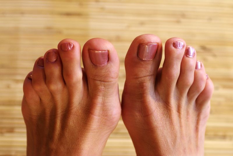 Hammertoes! How to treat based on type